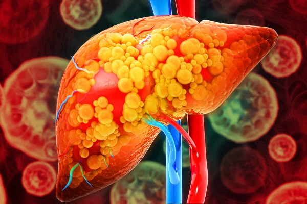 Hepatologistas contam os piores alimentos que causam gordura no fígado