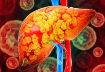dicas simples para evitar a esteatose hepática