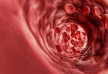 Cardiologista explica o que acontece no corpo quando artérias entopem