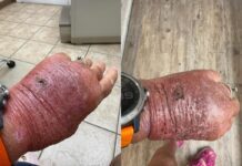 Corte com papelão infecciona e leva mulher de 63 anos ao hospital