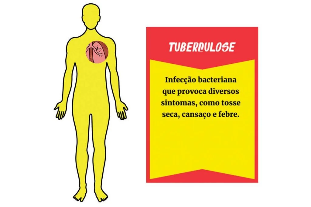Remédio contra tuberculose apresenta melhores resultados da história