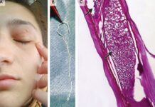 Verme vivo de 11 cm é retirado da pálpebra de mulher na Romênia