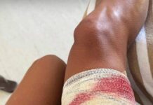 Tubarão-lixa Morde Turista Em Fernando De Noronha