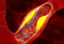 Cardiologistas explicam os principais sintomas de gordura nas artérias Ícone de sino para notificações