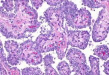 Endocrinologista lista os principais sintomas do câncer de tireoide Ícone de sino para notificações