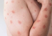 Oito Estados Entram Em Alerta Máximo Para Mpox No Brasil Oito Estados Entram Em Alerta Máximo Para Mpox No Brasil