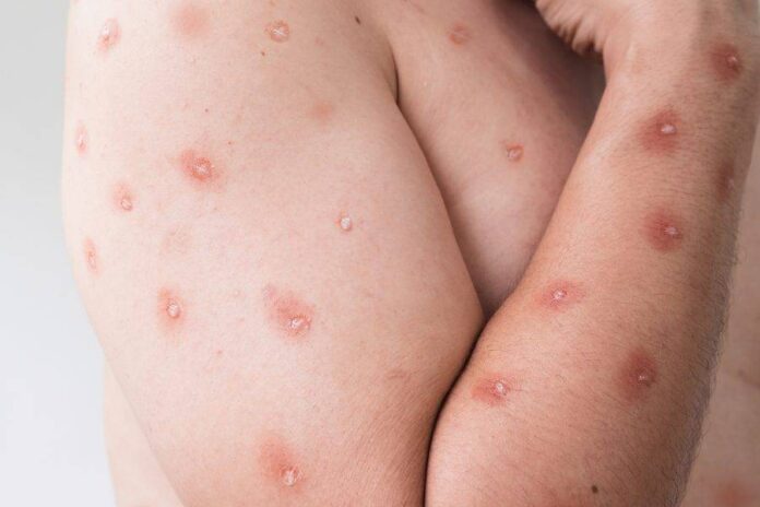 Oito Estados Entram Em Alerta Máximo Para Mpox No Brasil Oito Estados Entram Em Alerta Máximo Para Mpox No Brasil