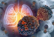 Oncologistas explicam os principais sintomas do câncer de pulmão Ícone de sino para notificações