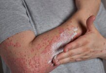Stresse pode ativar e agravar crises de dermatite atópica, diz estudo Ícone de sino para notificações