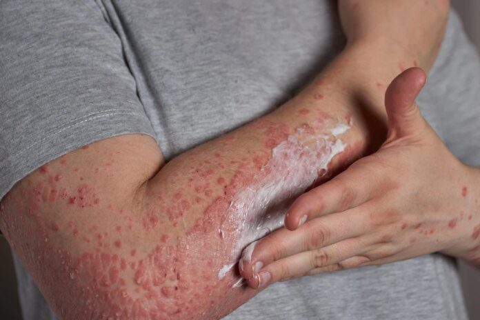 Stresse pode ativar e agravar crises de dermatite atópica, diz Ícone de sino para notificações
