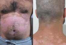 “Achei que não teria mais vida a dois”, diz paciente com psoríase grave Ícone de sino para notificações