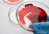 Exame de sangue ajuda a prever recidiva do câncer de pâncreas Exame de sangue ajuda a prever recidiva do câncer de pâncreas