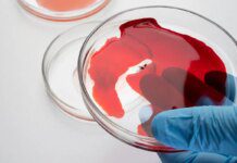 Exame de sangue ajuda a prever recidiva do câncer de pâncreas Exame de sangue ajuda a prever recidiva do câncer de pâncreas