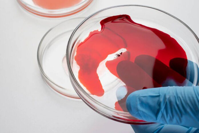 Exame de sangue ajuda a prever recidiva do câncer de pâncreas