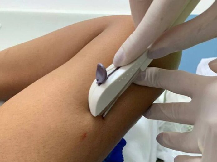 Implanon Passa A Ter Eficácia De Cinco Anos Após Decisão Implanon Passa A Ter Eficácia De Cinco Anos Após Decisão Da Anvisa